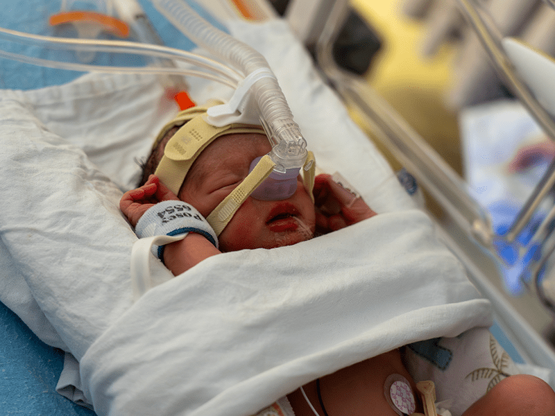 Photo: A NICU baby with a CPAP at Waterloo Regional Health Network